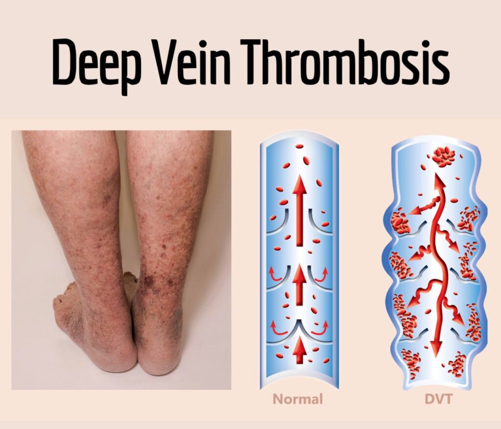 deep vein thrombosis 1