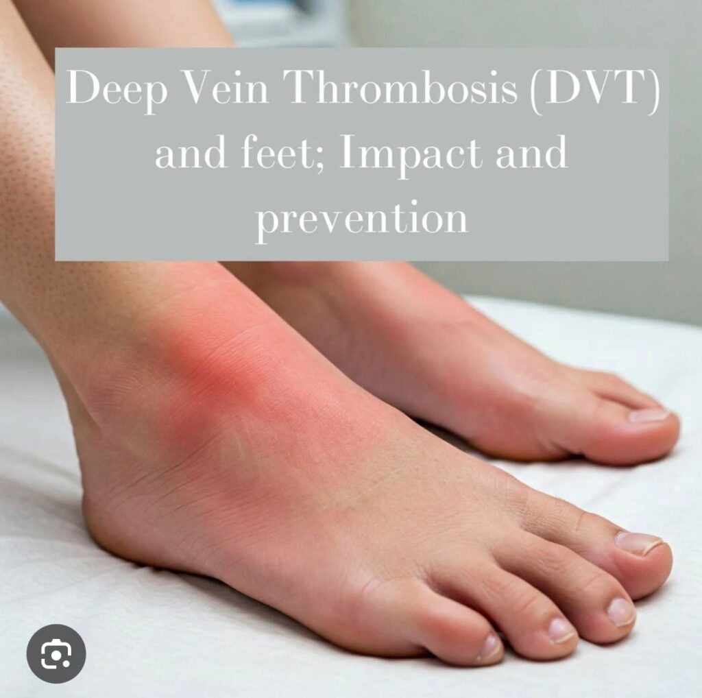deep vein thrombosis