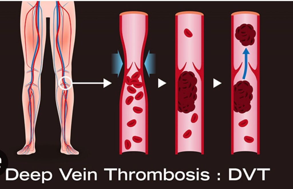 deep vein thrombosis 2