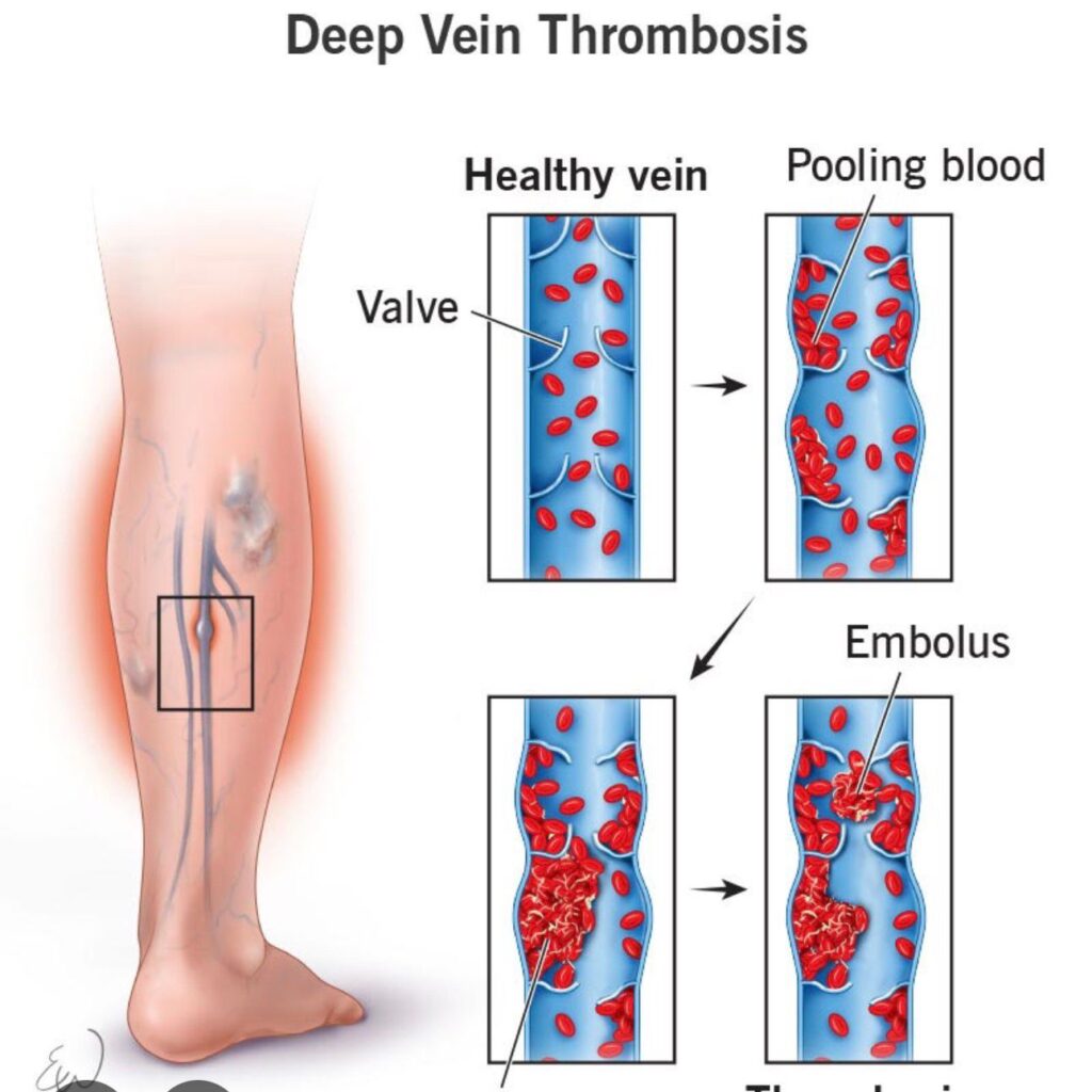 deep vein thrombosis 3