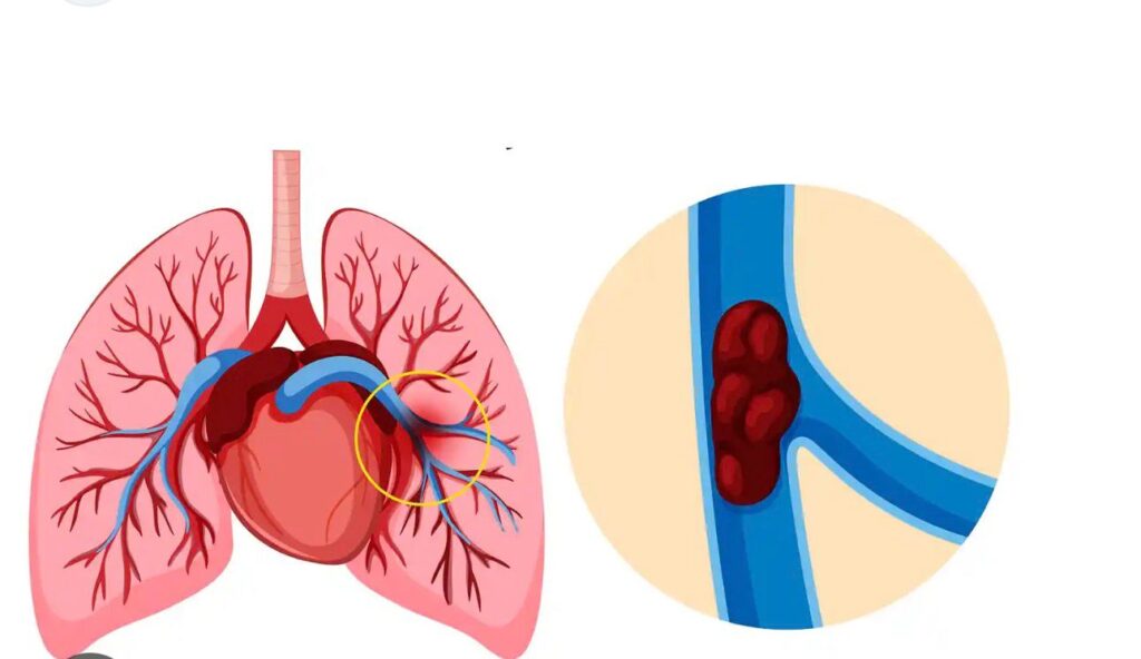 saddle pulmonary embolism 1