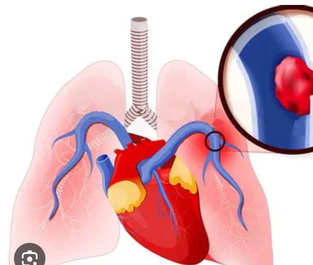 saddle pulmonary embolism heartplace