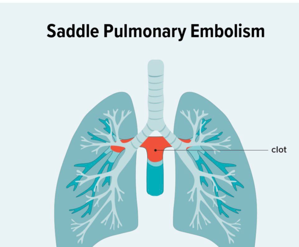 saddle pulmonary embolism